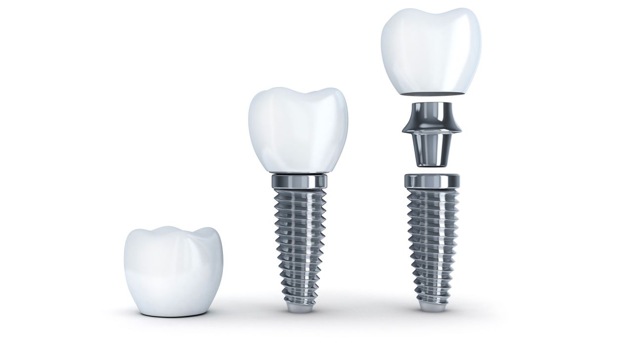 Dental Implants at Unique Smiles