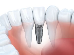 Dental implant next to normal teeth